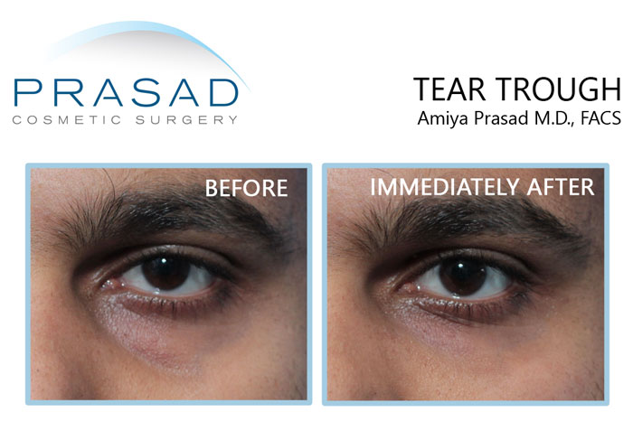 fillers for under eye bag treatment before and immediately after comparison of results - young male patient