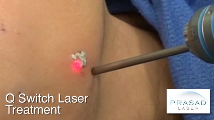 hyperpigmentation sun spots treatment with laser at Prasad Cosmetic Surgery