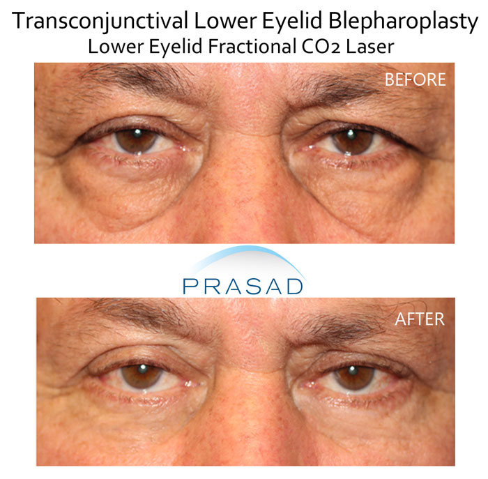 before and after lower eyelid blepharoplasty full recovery of male patient in 60s. Procedure performed by Dr. Amiya Prasad New York office