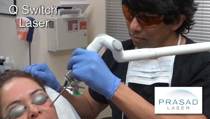 hyperpigmentation sun damage treatment using Q Switch Laser at Prasad Cosmetic Surgery