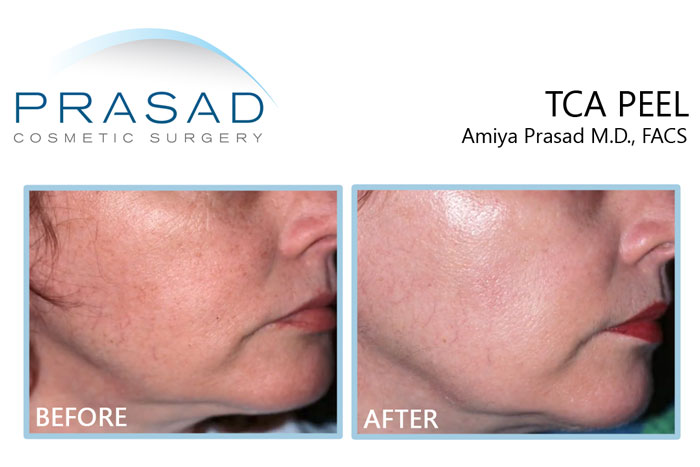 tca peel before and after by Dr. Amiya Prasad