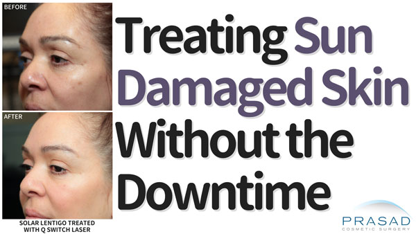 treating-sun-damaged-skin-without-the-downtime