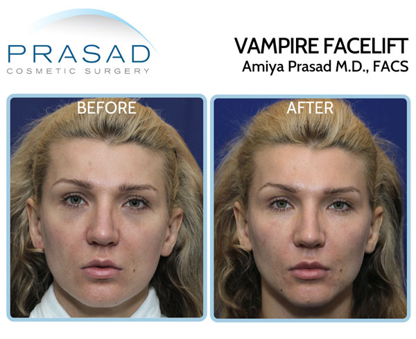 vampire facelift before and after results comparison, young female patient, procedure performed by Dr Amiya Prasad New York