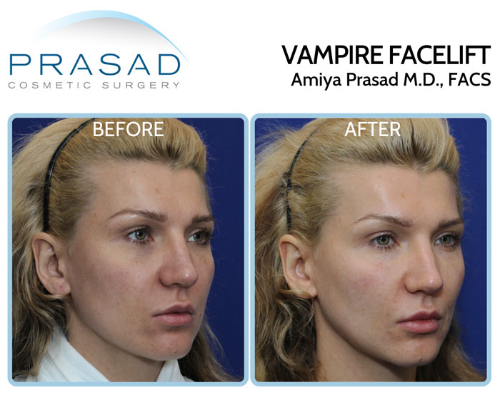 Vampire Facelift performed by Amiya Prasad MD before and after results - female patient