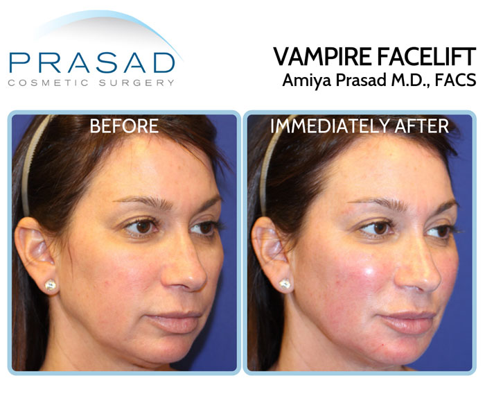 Immediate results of vampire facelift on female patient