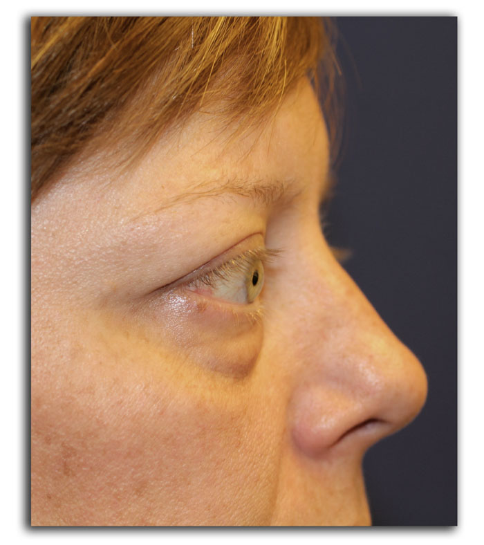 a woman with Graves eye disease sideview