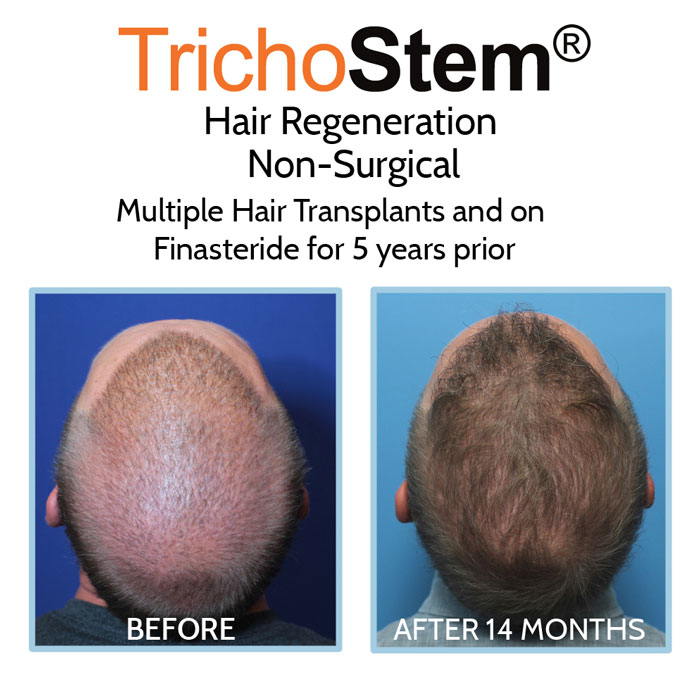 male patient who had several hair transplant improved hair growth after Hair Regeneration treatment