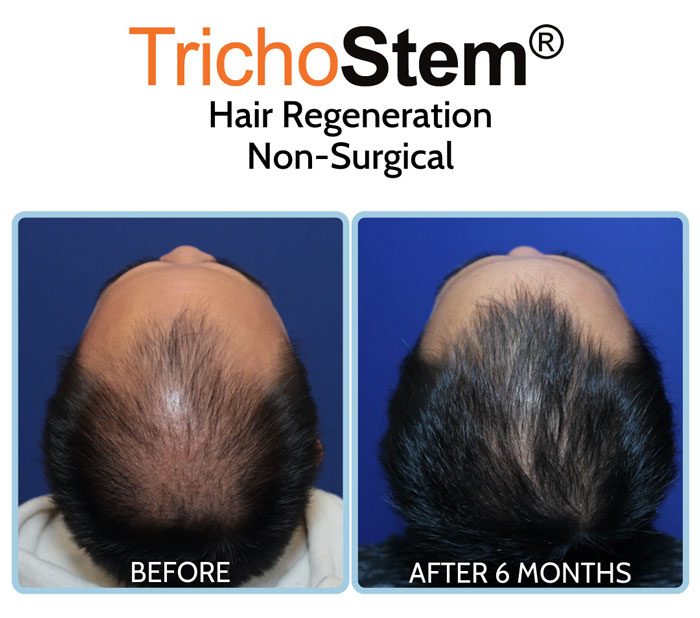 hair thinning treatment for male in 20s - hair regeneration before and after results comparison