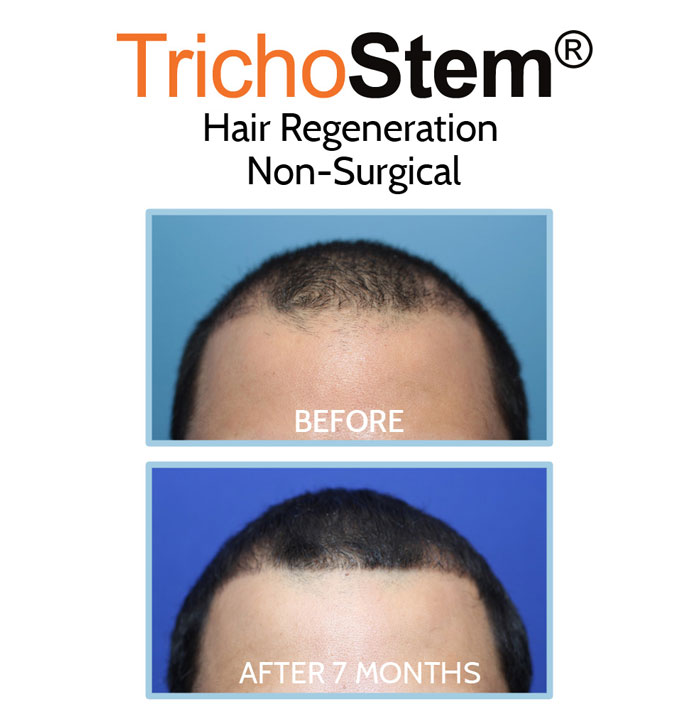 hair regeneration before and after 7 months results comparison - young male patient