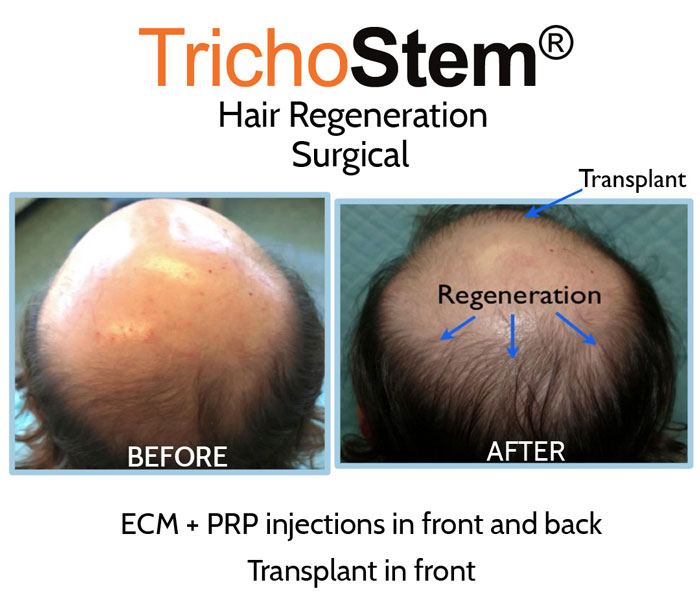 post-hair transplant care with Trichostem Hair Regeneration, before and after treatment