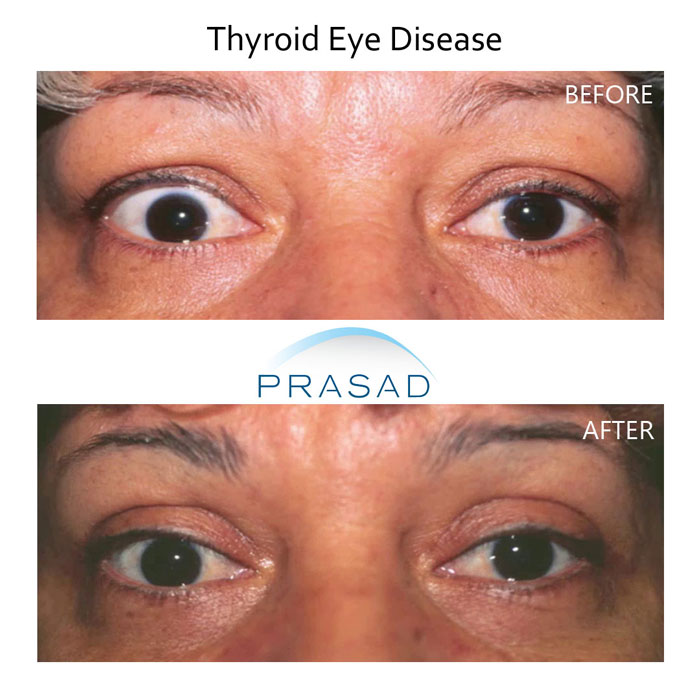 thyroid eye disease before and after - middle aged female patient