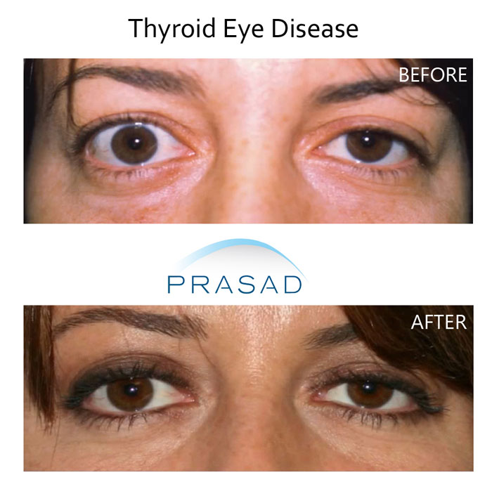 Thyroid Eye Disease Surgery to fix eyelids retracted before and after results comparison