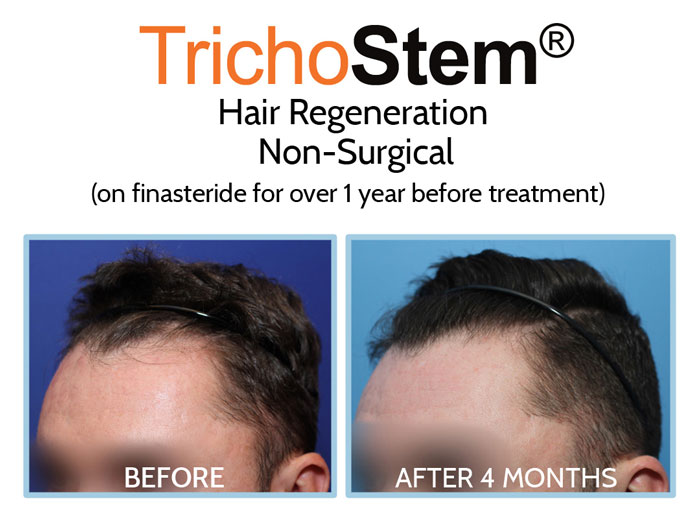 hair regeneration for young male patient, procedure perfromed by Dr. Amiya Prasad New York