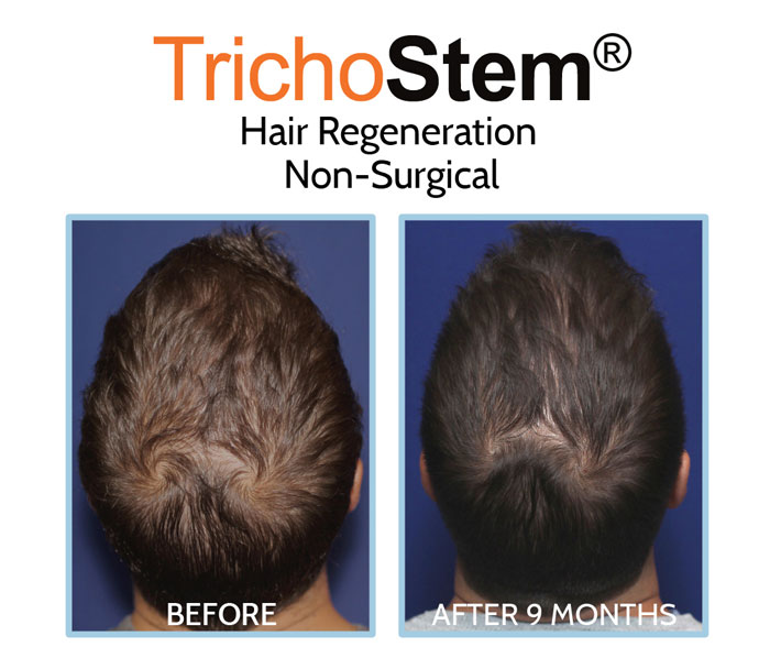 hair loss treatment for male in 20s - hair regeneration before and after results comparison