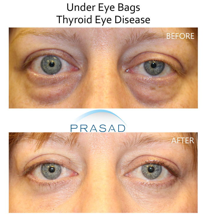 Eyelid retraction surgery before and after results - female patient