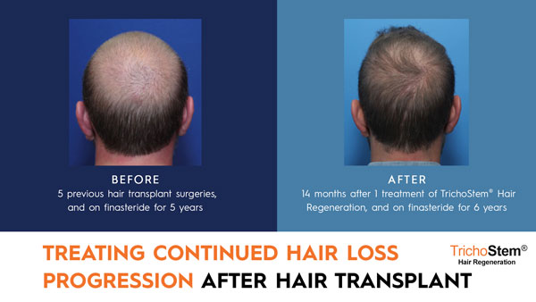 treating continued hair loss progression after hair transplant