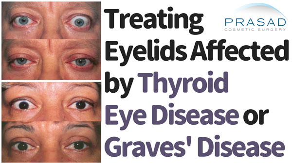 treating eyelids affected by thyroid eye disease or Graves disease