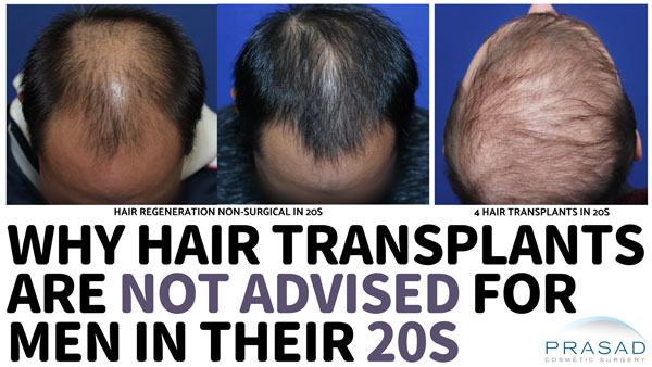 why hair transplant are not advised for hair loss in your 20s