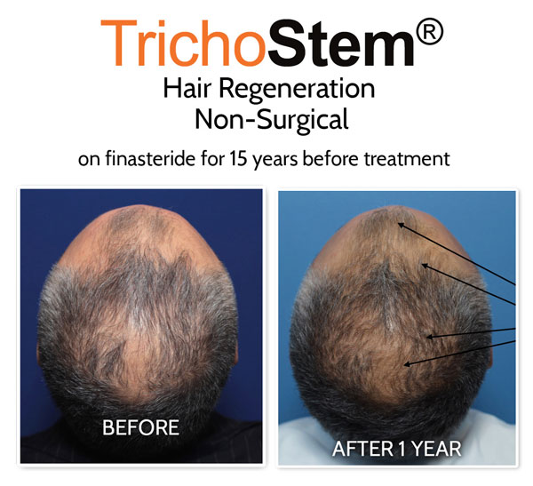 before and after Hair Regeneration for Hair Loss treatment, this male patient is a Finasteride user