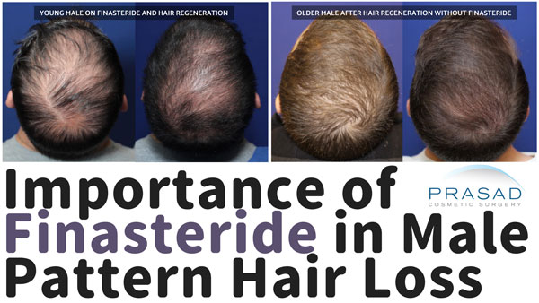 importance of Finasteride in male pattern hair loss