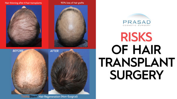 hair transplant surgery results comparison with TrichoStem Hair Regeneration results with the text Risks of Hair Transplant Surgery