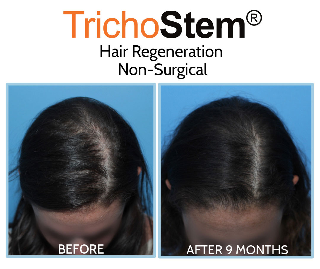 Hair Regeneration before and after 9 months results on female patient