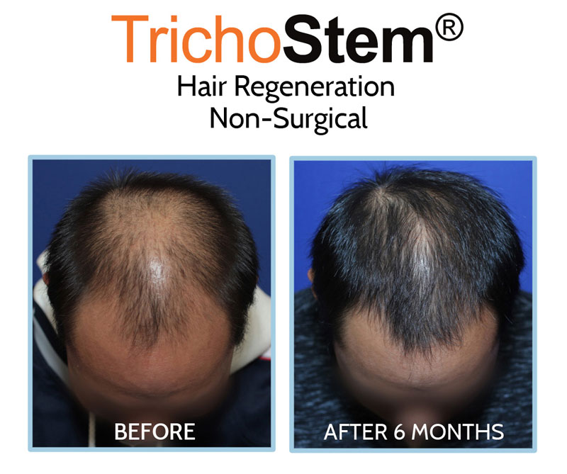 Hair Regeneration before and after results on male patient in late 20s