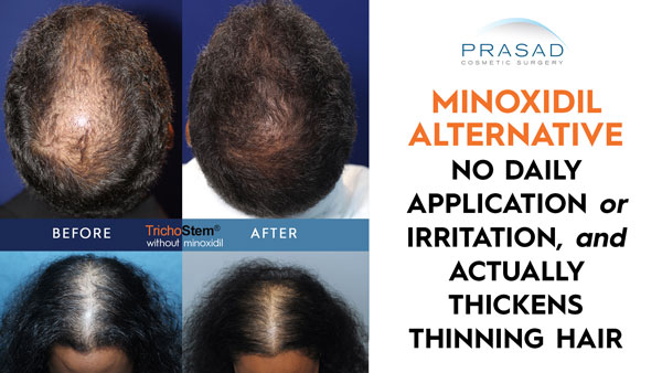 minoxidil alternative with no daily application or irritation