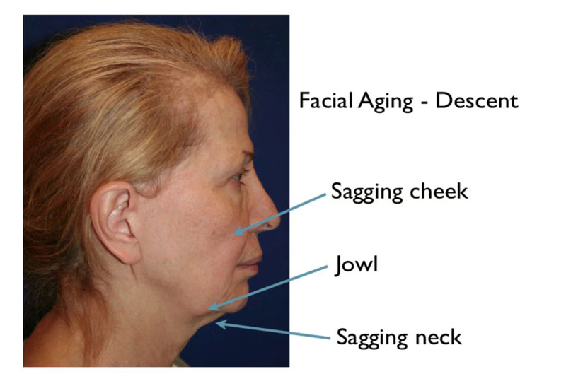 facial aging illustration on a woman in 60s