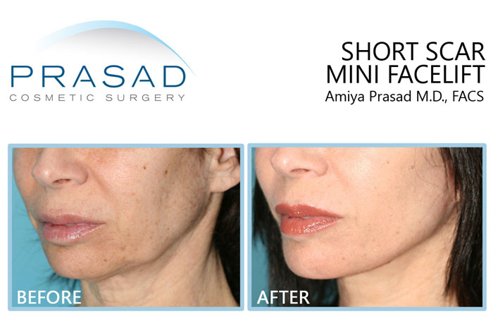 a female patient undergoes mini facelift, this is a before and after results