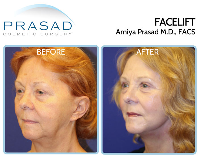 female patient in 70s undergoes facelift and eyelifts, this is before and after results comparison