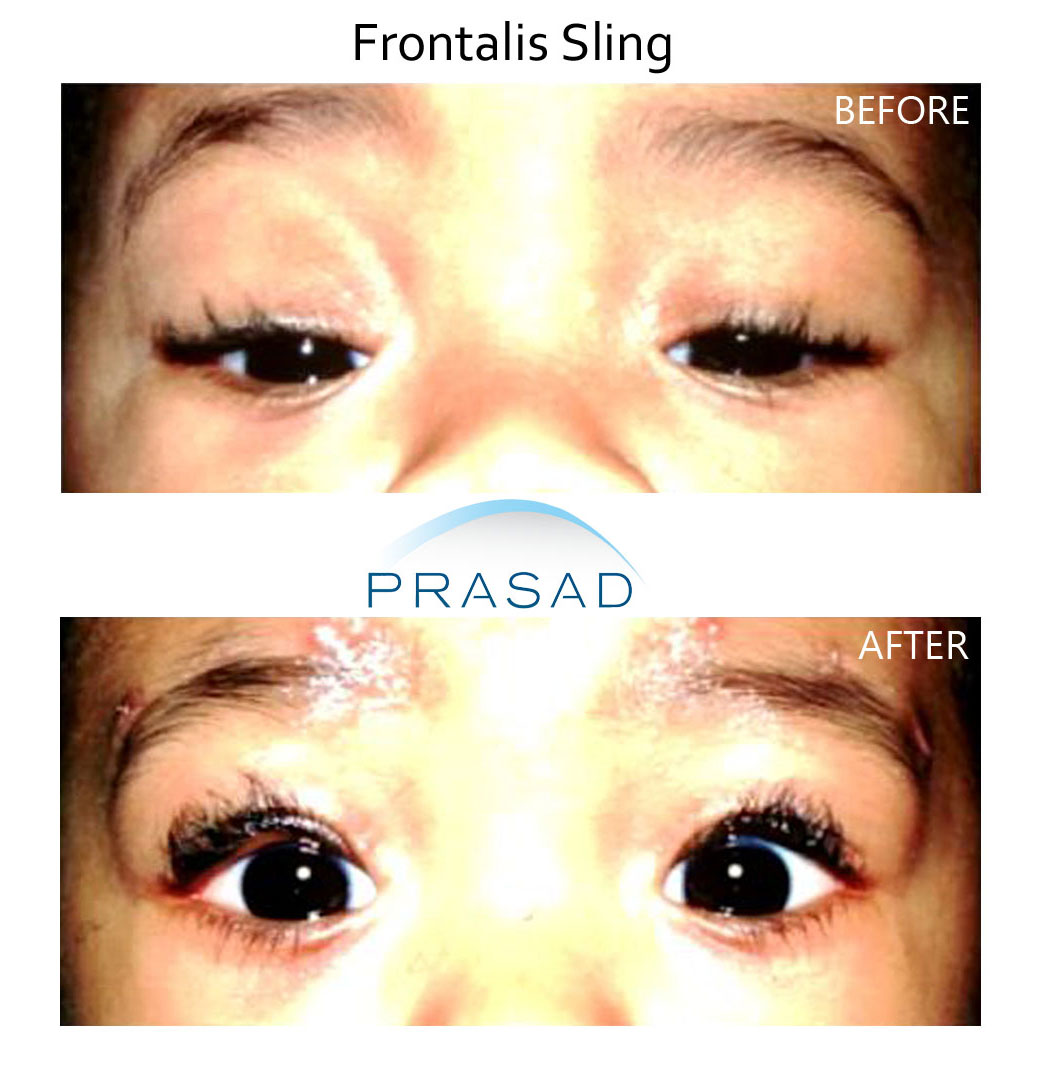 before and after ptosis surgery of a 2 years old patient, surgery performed by oculoplastic surgeon Dr. Amiya Prasad