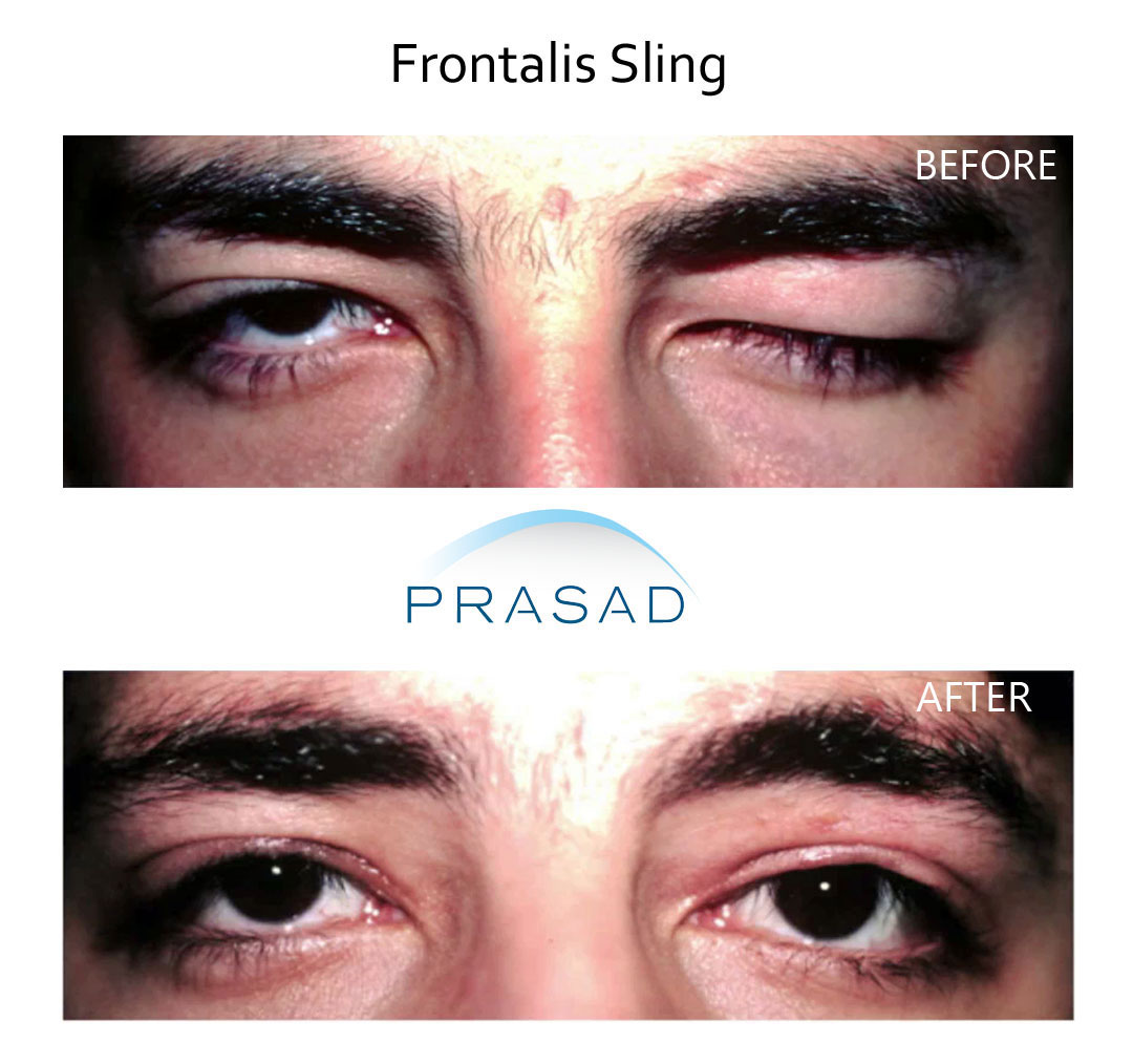 before and after ptosis surgery on adult male patient who had frontalis sling, surgery performed by Dr. Amiya Prasad