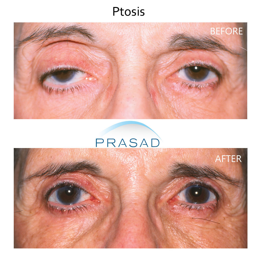 before and after ptosis surgery on old female patient, surgery performed by oculoplastic surgeon Dr. Amiya Prasad