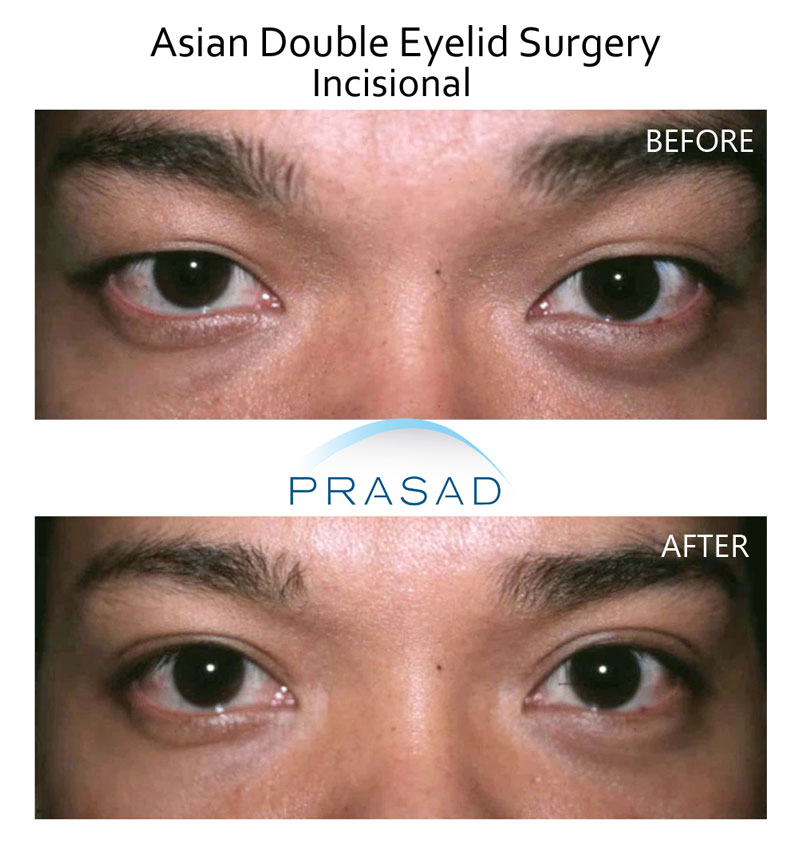 young male patient before and after double eyelid surgery. after photo shows eyelid crease