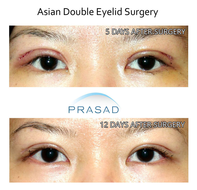 Healing progression of young female patient week after Asian Blepharoplasty, swelling is minimal