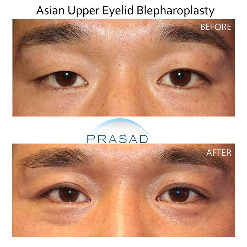 Asian eyelid surgery on young male patient, before and after comparison