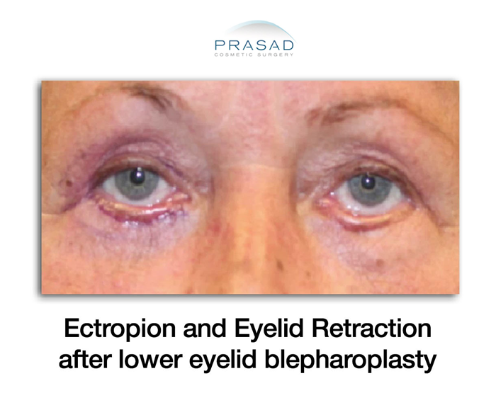 patient who experienced complications after lower blepharoplasty from other doctor