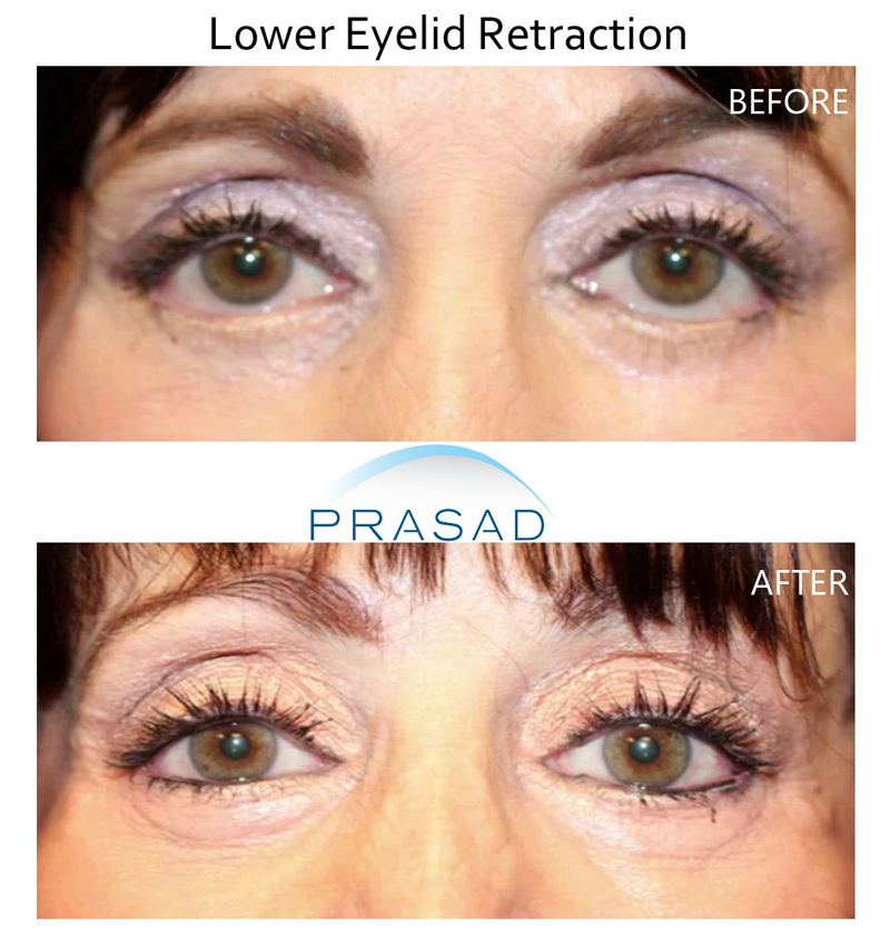 female patient who undergoes lower eyelid retraction surgery, before and after surgery comparison