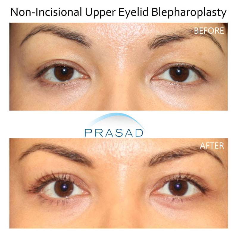 female patient undergoes non-incisional Asian blepharoplasty, before and after results comparison