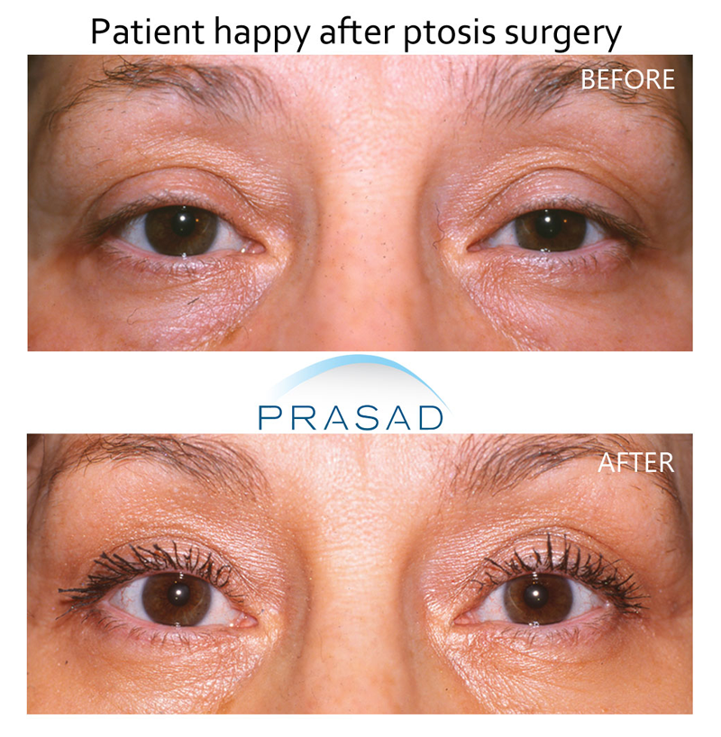 ptosis correction surgery before and after on female patient