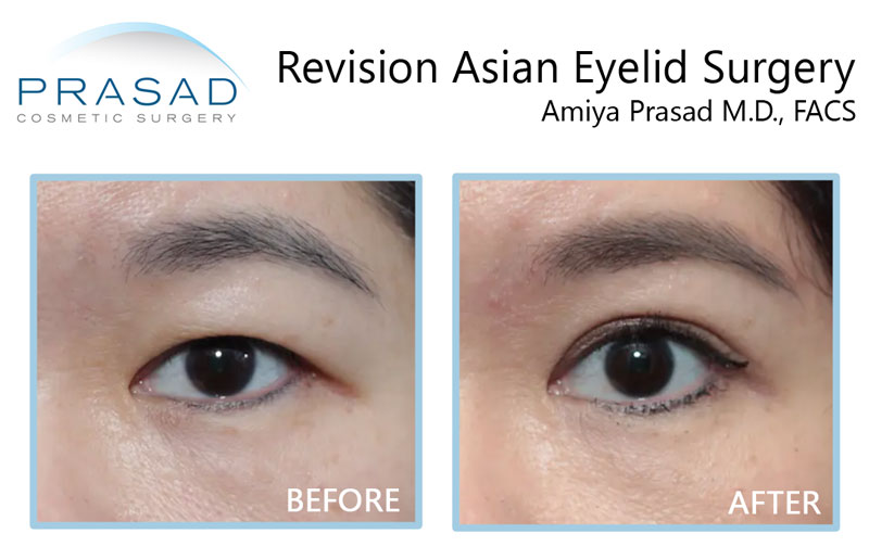 young female patient undergoes revision Asian eyelid surgery before and after surgery comparison