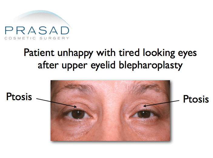patient who needed ptosis surgery after upper blepharoplasty