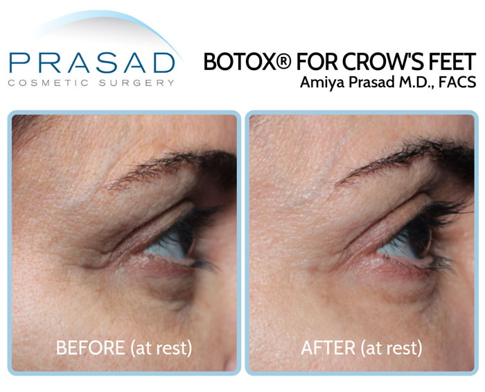 Botox for crow's feet lines and under eye wrinkles, before and after results comparison
