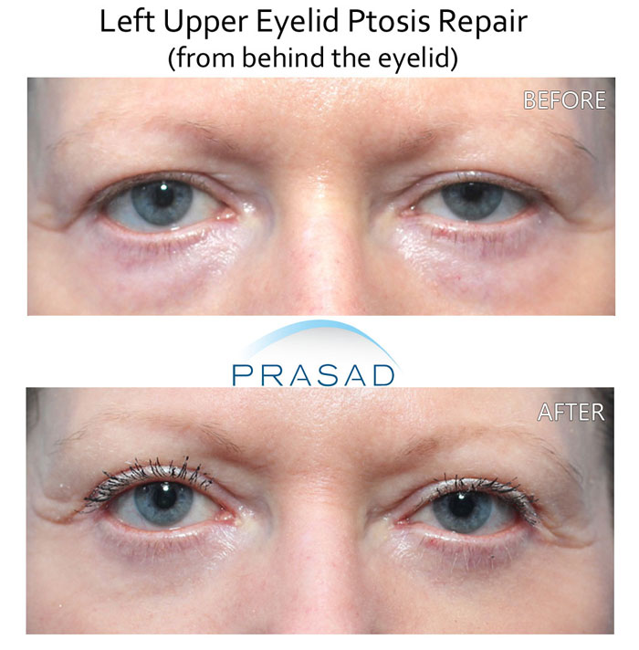 before and after ptosis surgery of a female patient who underwent ptosis correction on her left eyelid