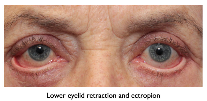 a woman suffered from complication (ectropion lower eyelid retraction) after lower blepharoplasty