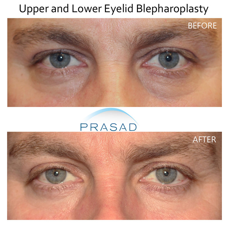 before and after upper and lower blepharoplasty - male patient of Dr. Amiya Prasad