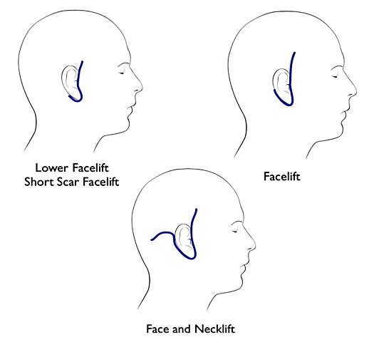 types of facelift incisions