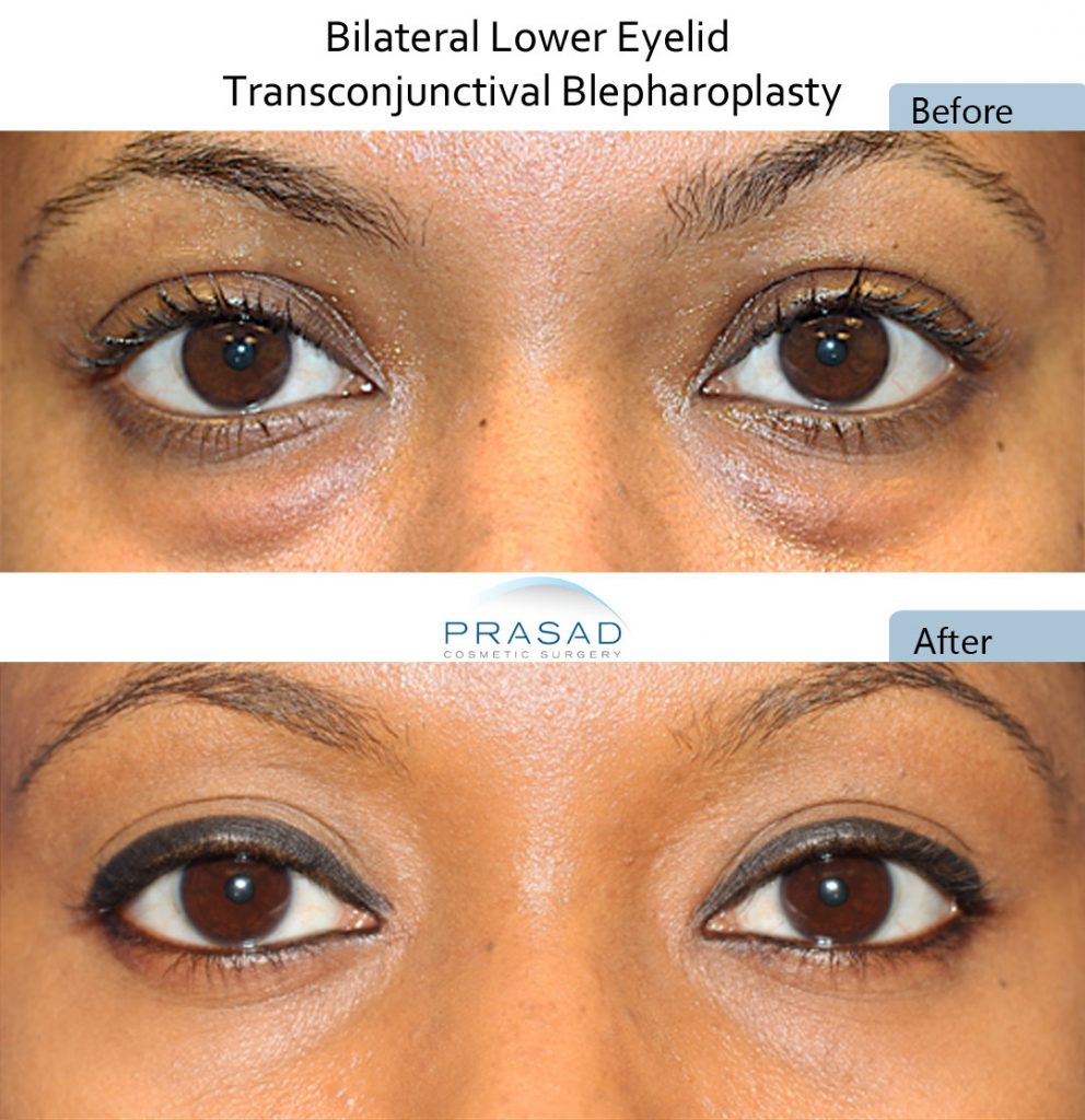 Plasma Eyelid Lift | Eye Bag Reduction Manchester