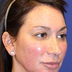 After Vampire Facelift by Dr Amiya Prasad